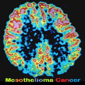 What is Mesothelioma?